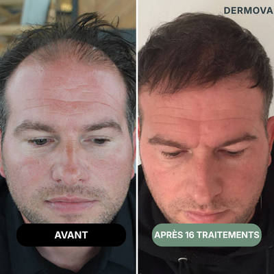 Kit de renouvellement capillaire