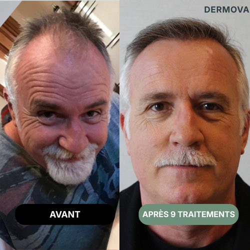 Protocole de Renouvellement Capillaire