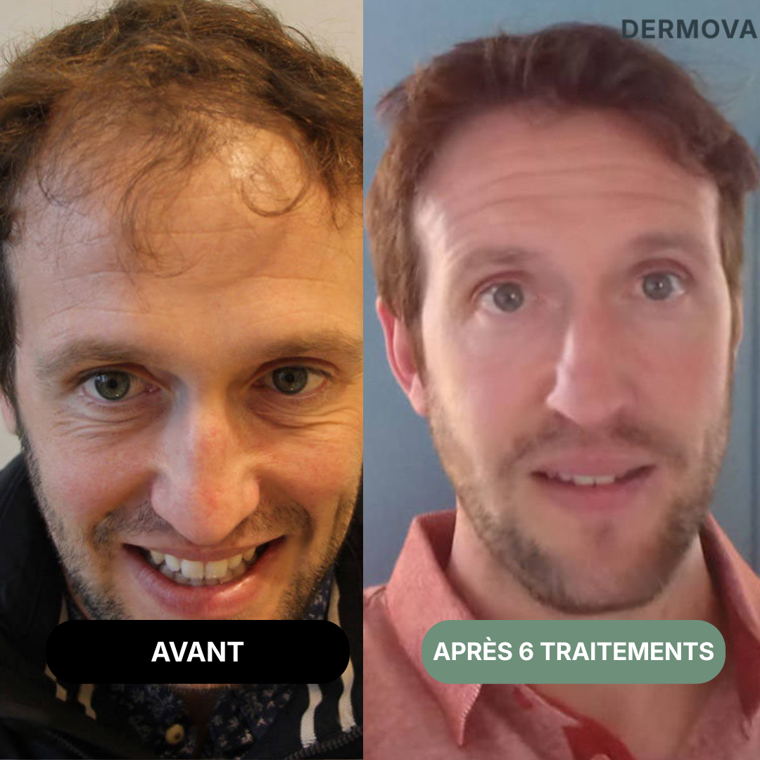 Kit de renouvellement capillaire